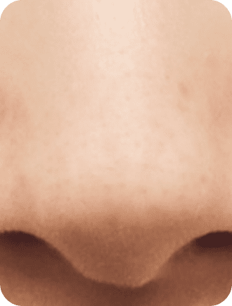 毛穴に汚れが詰まった鼻